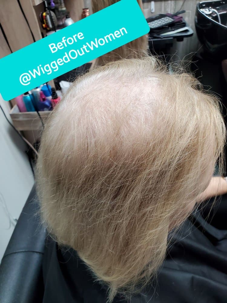 Wigged Out Women - hair transplant in Simpsonville, SC