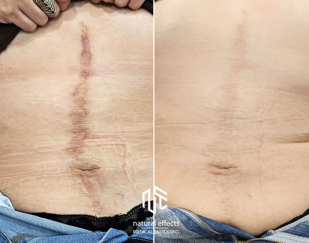 Natural Effects Medical Tattooing - hair transplant in Sacramento, CA