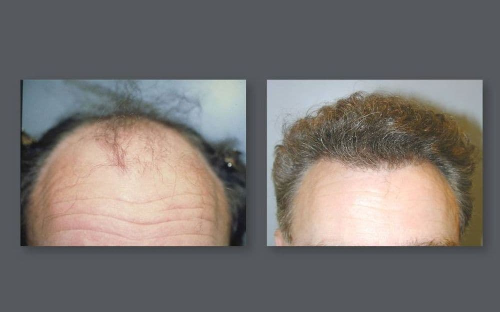 NeoGraft Hair Restoration Infinity Skin Care Andrews Plastics - hair transplant in Coralville, IA