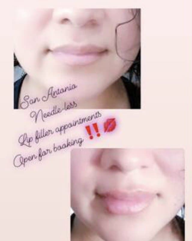 Pretti &nd The Pink - hair transplant in Dallas, TX