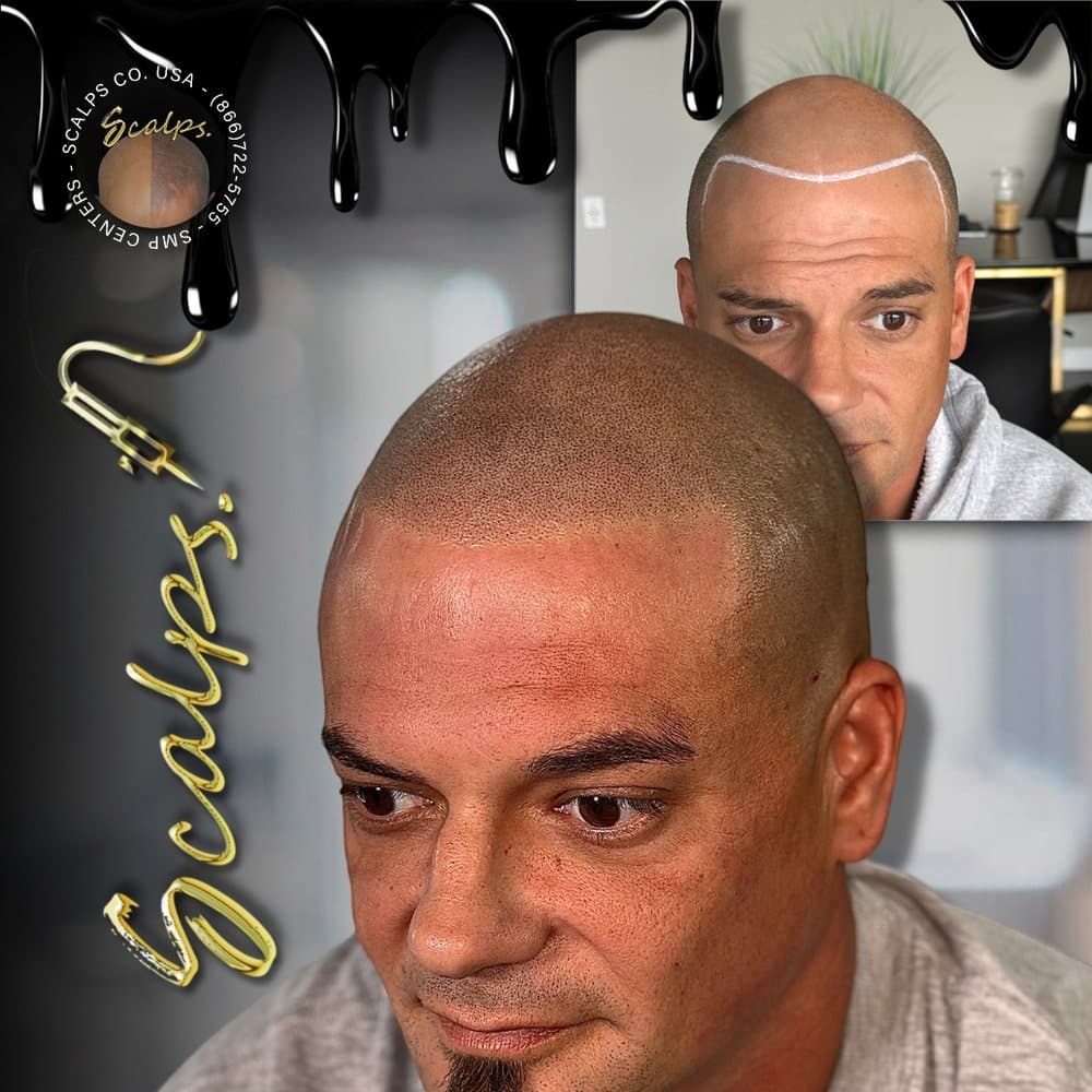 SCALPS - Scalp Micropigmentation Centers - hair transplant in Princeton, NJ