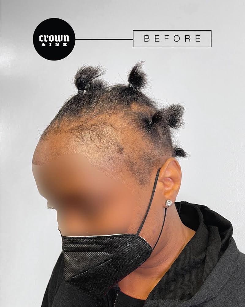 Crown & Ink - hair transplant in Columbia, MD