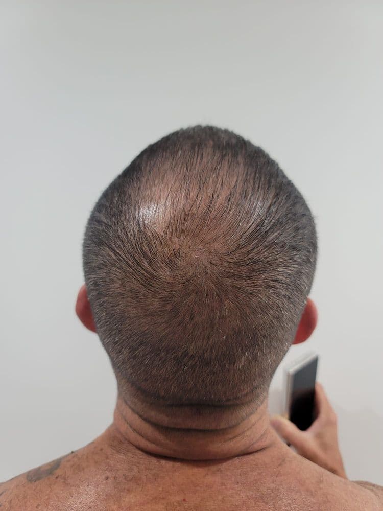 Care4Hair - hair transplant in Miami, FL
