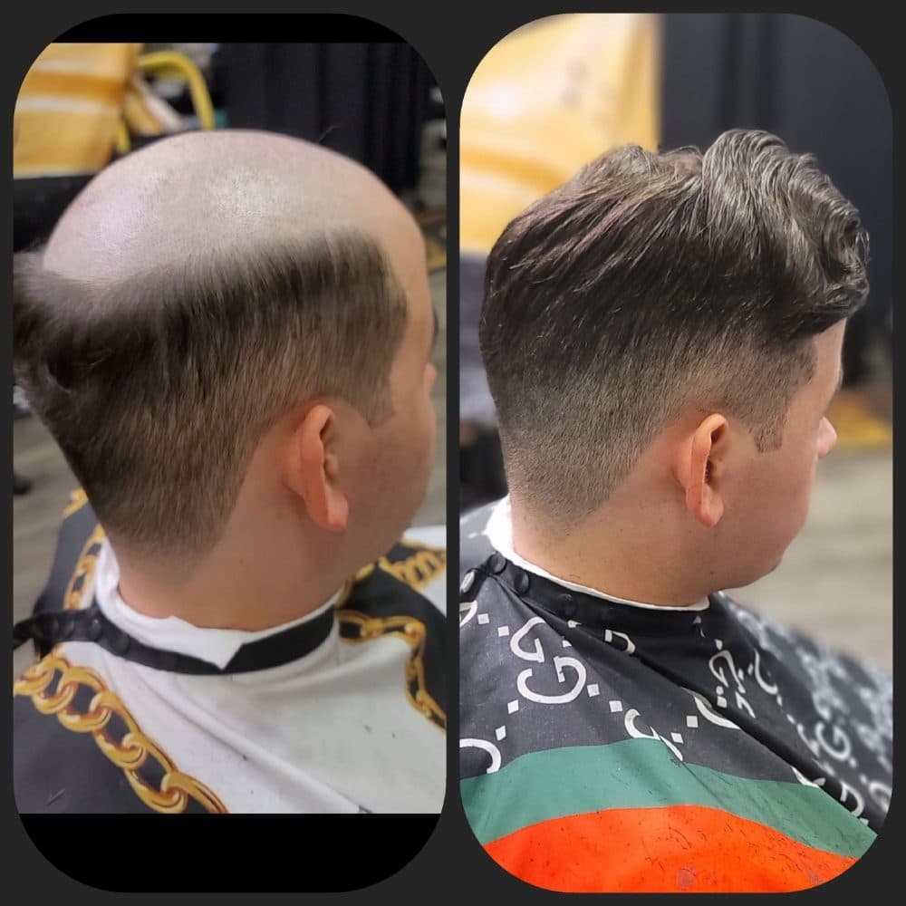 Man Weave Exclusive - hair transplant in Stonecrest, GA