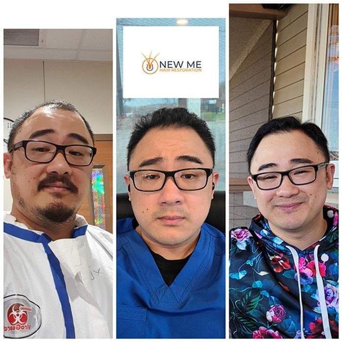 The New Me Hair Restoration - hair transplant in Richardson, TX