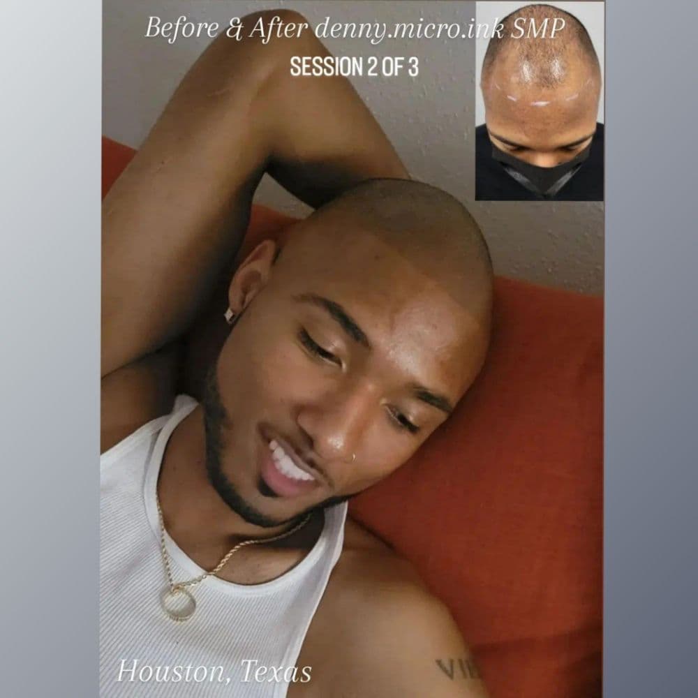 Denny Micro Ink - hair transplant in Bellaire, TX