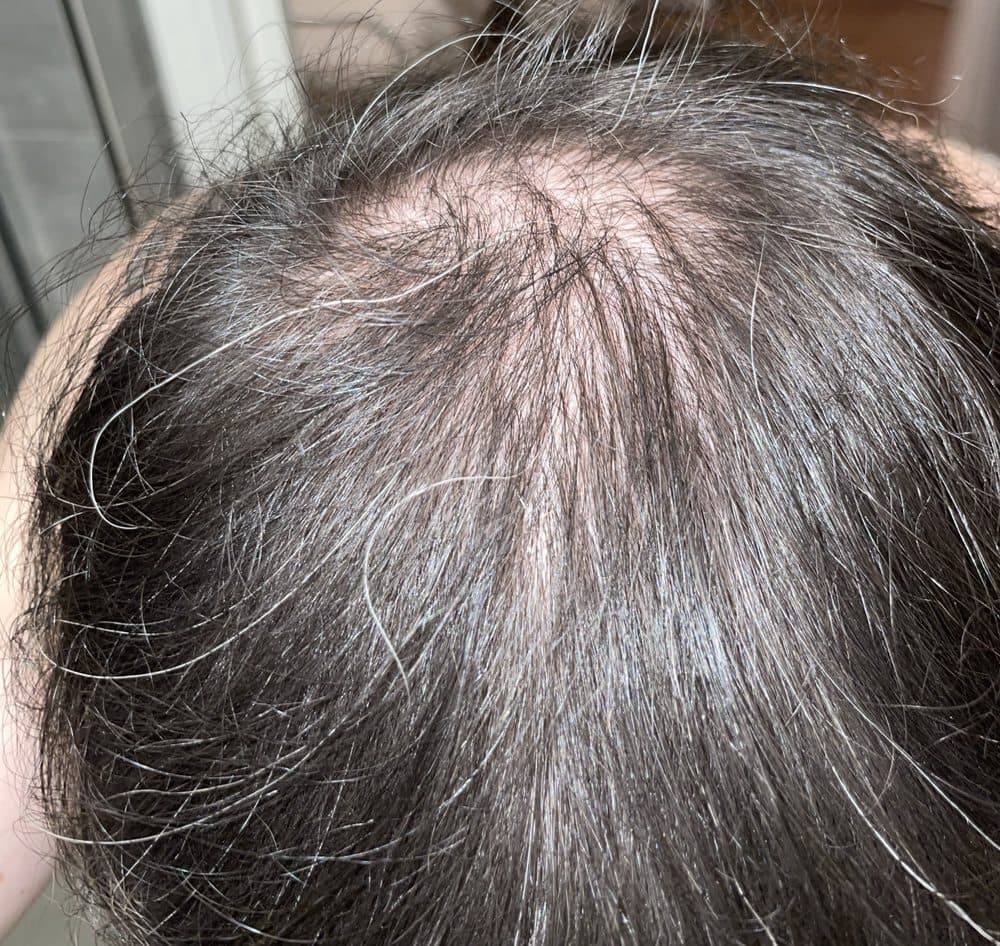 Medical Hair Transplant & Aesthetics - hair transplant in San Francisco, CA