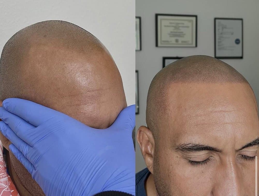 Scalp Micro - hair transplant in Kansas City, MO