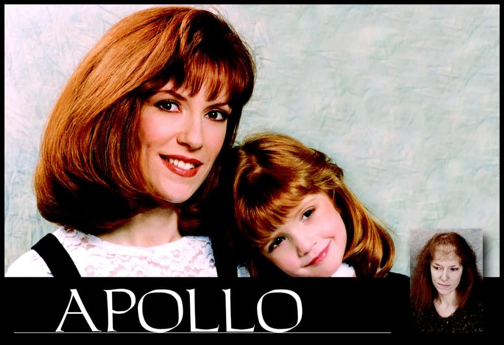 Apollo Hair Systems - hair transplant in San Antonio, TX