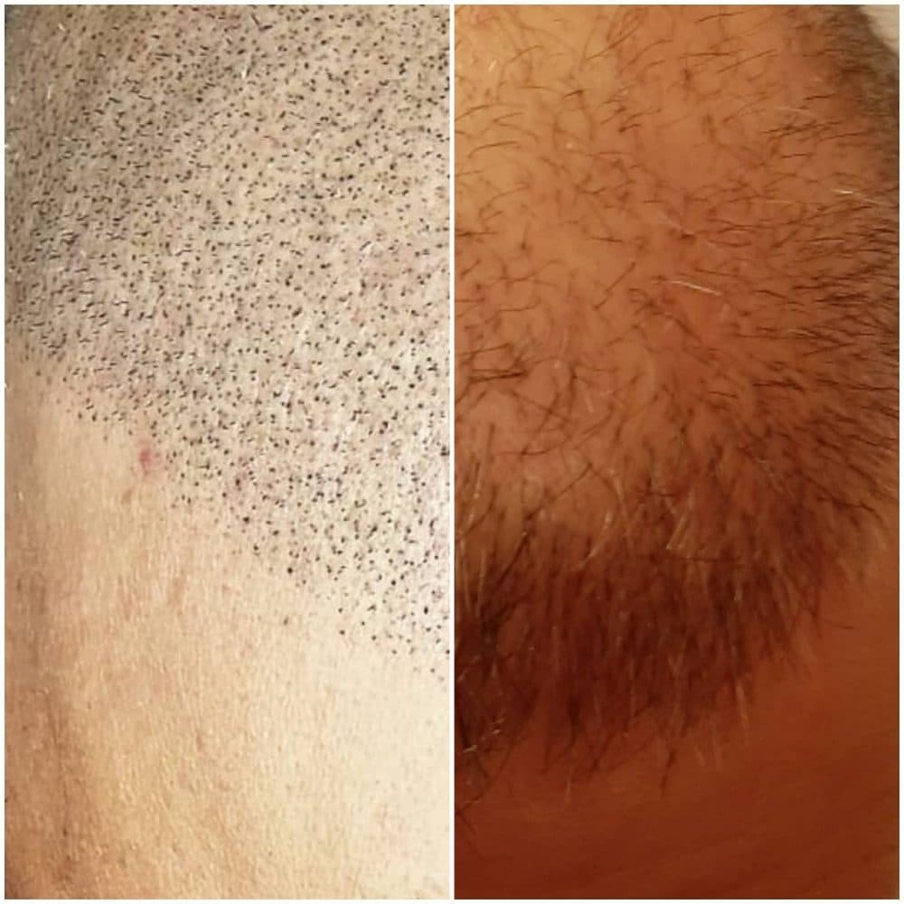 Scalp2go - Scalp Micropigmentation - hair transplant in Peabody, MA