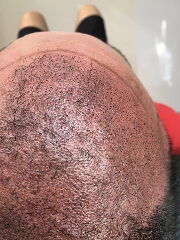 CustomScalp - hair transplant in Greenfield, WI