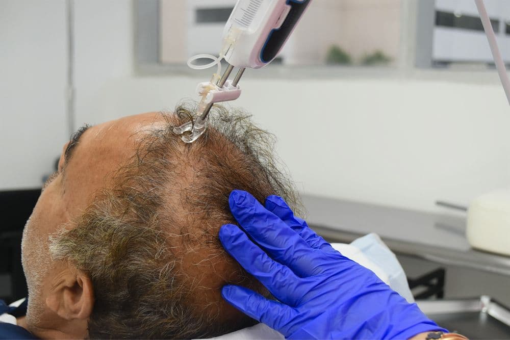American Mane - hair transplant in Aventura, FL