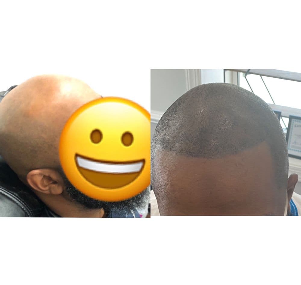 Ahead of the Game Men Spa - hair transplant in Reisterstown, MD