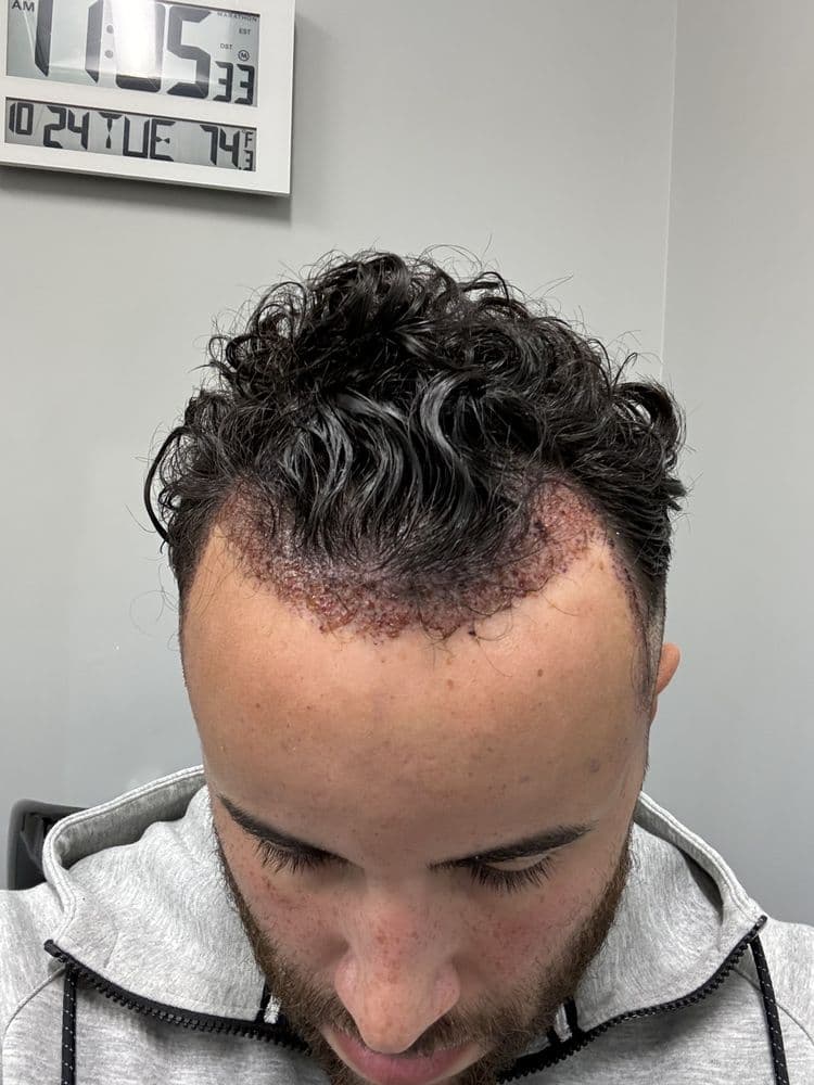 Anderson Center for Hair - hair transplant in Alpharetta, GA