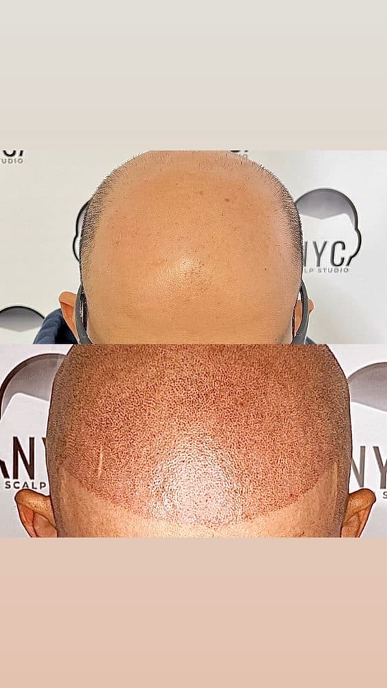 NYC Scalp Studio - hair transplant in Brooklyn, NY