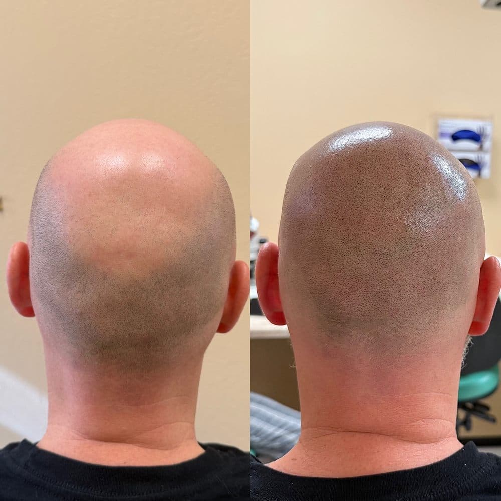 3D Camouflage AZ - hair transplant in Phoenix, AZ