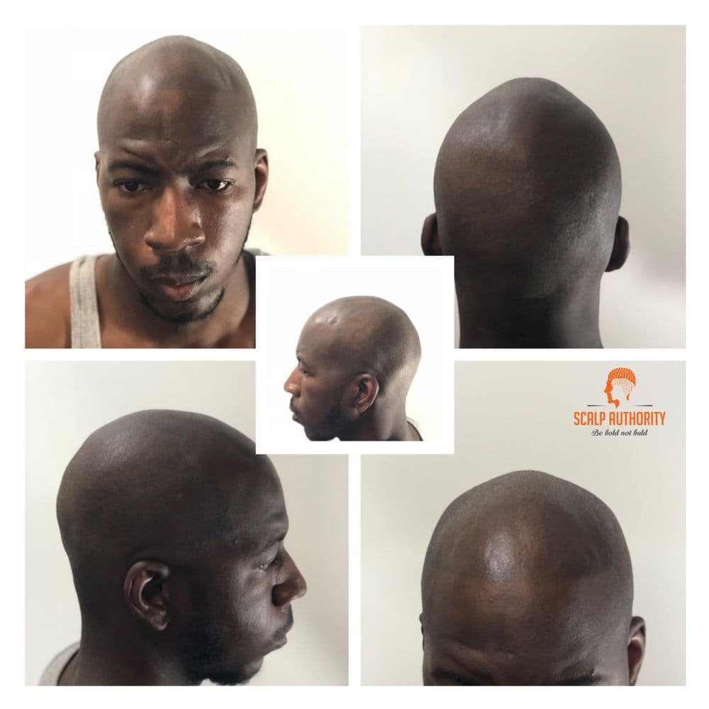 Scalp Authority - hair transplant in Farmington Hills, MI