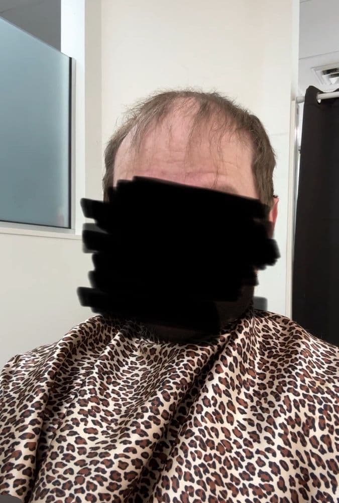 Angie's Hair Replacement - hair transplant in Portland, OR