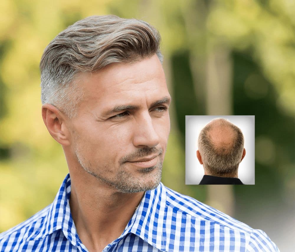 Innovative Hair Solutions - hair transplant in Springfield, MO