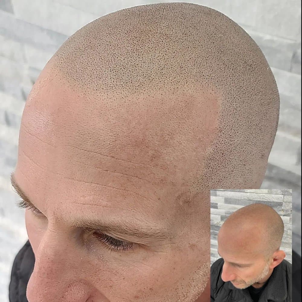 ScalpCo - San Jose - hair transplant in San Jose, CA