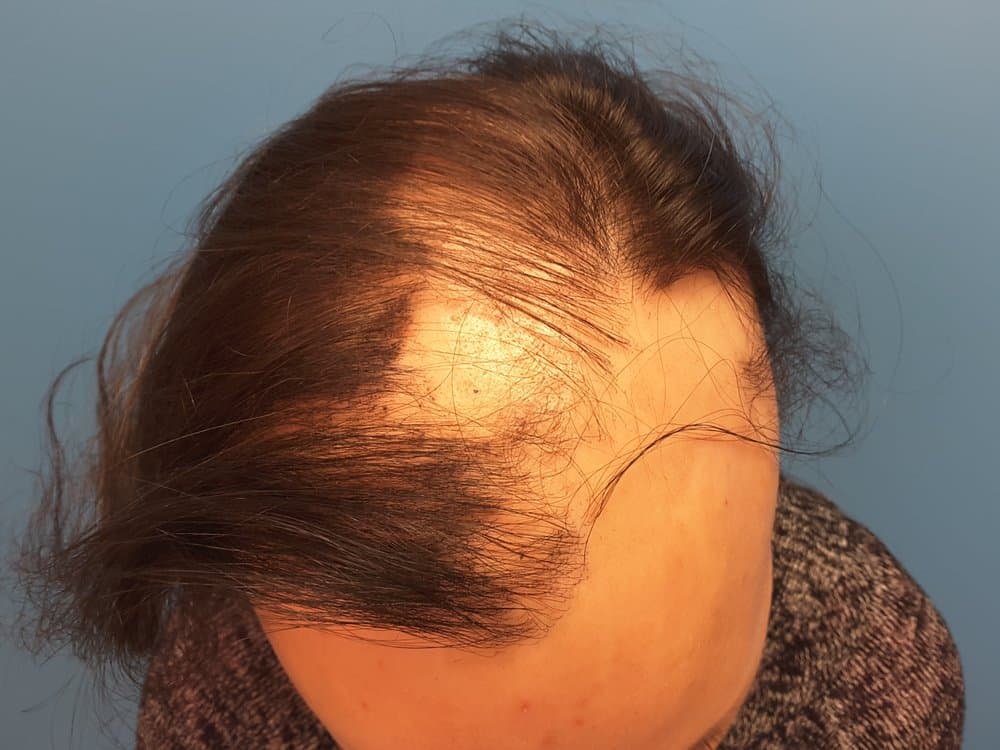 Root Harvest Artist - hair transplant in Chicago, IL