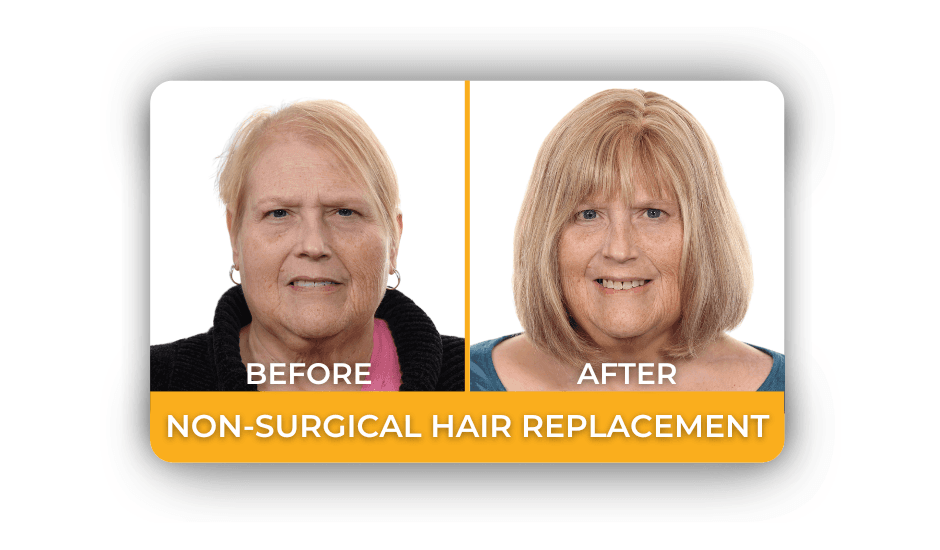 Transitions of Indiana - hair transplant in Indianapolis, IN