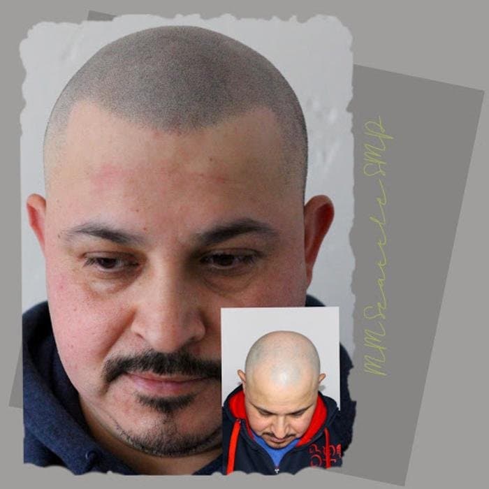 MM Seattle SMP - hair transplant in Seattle, WA