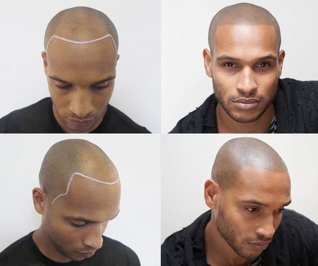 Flawless SMP - hair transplant in Gardena, CA