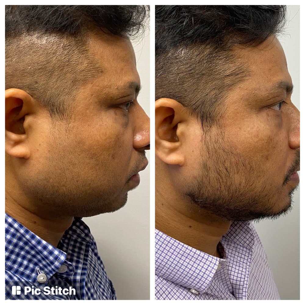 Anthony Farole, DMD - hair transplant in Bala Cynwyd, PA