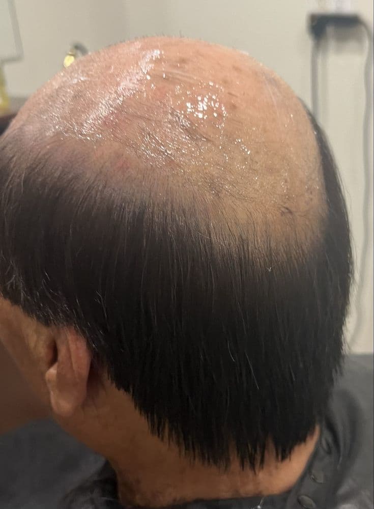 The Hair Circuit - hair transplant in Stoughton, MA