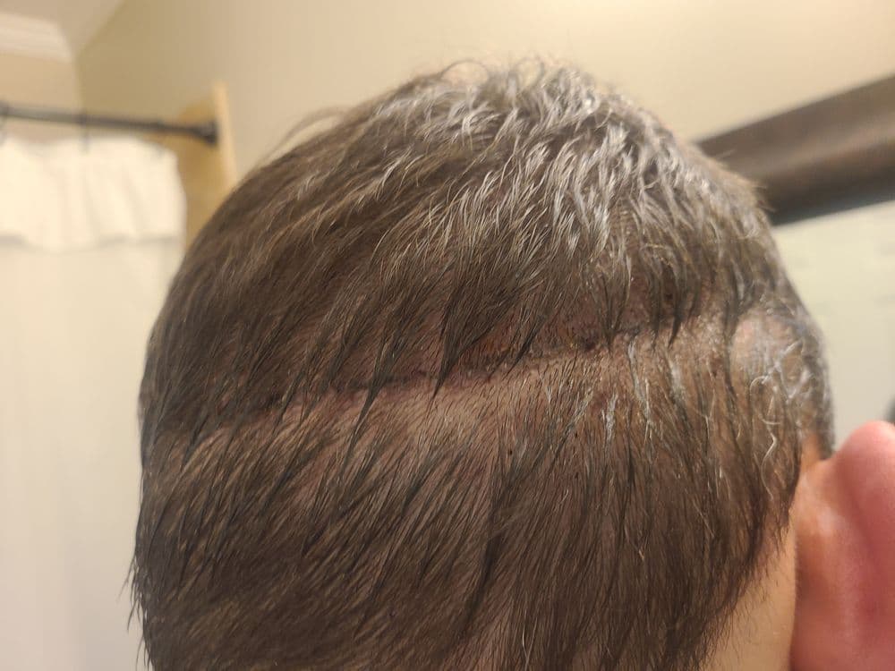 Anderson Center for Hair - hair transplant in Atlanta, GA