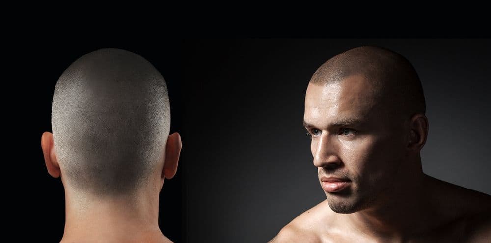 SMP Treatment - hair transplant in San Francisco, CA
