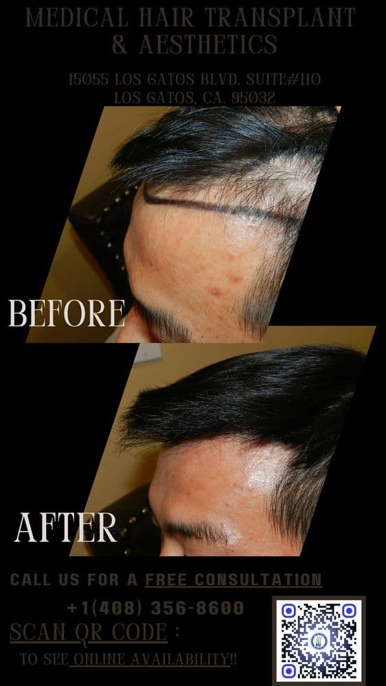 Medical Hair Transplant & Aesthetics - hair transplant in Los Gatos, CA