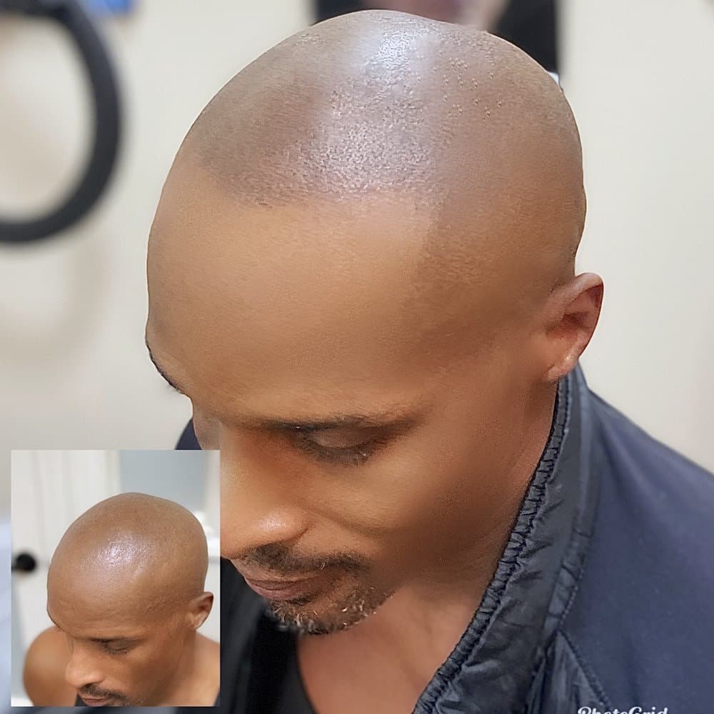 Skalp Los Angeles - hair transplant in Westminster, CA