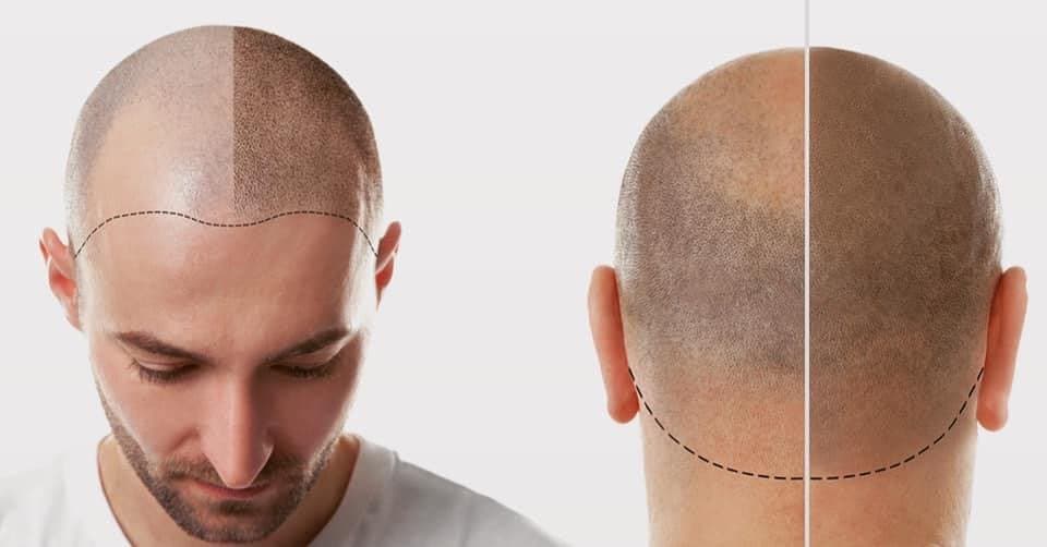 Hair Cliniq - hair transplant in Tampa Bay, FL