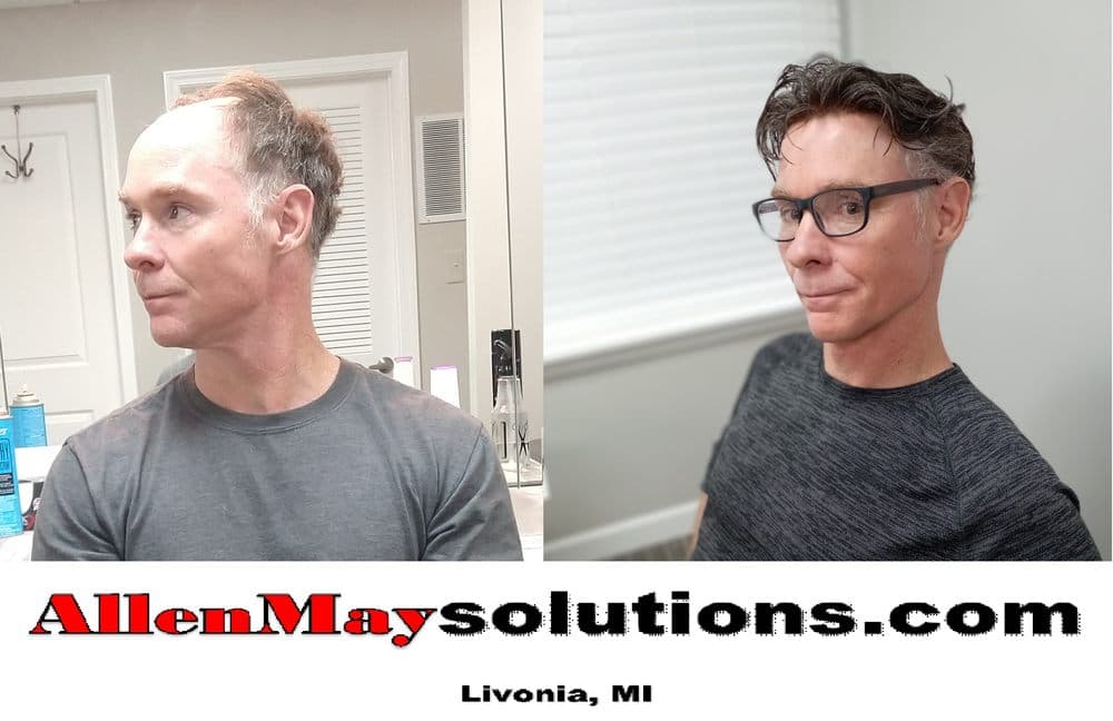 Allen May Solutions - hair transplant in Livonia, MI