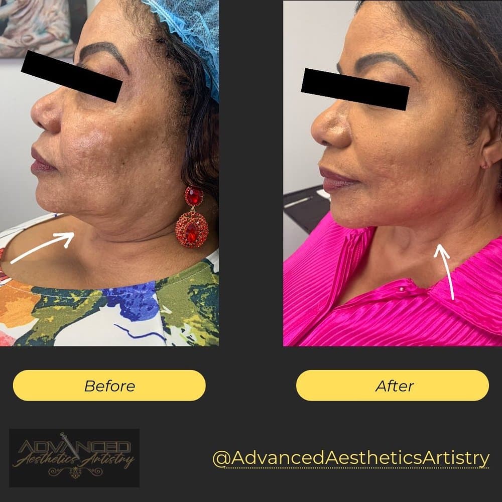 Advanced Aesthetics Artistry - hair transplant in Lilburn, GA