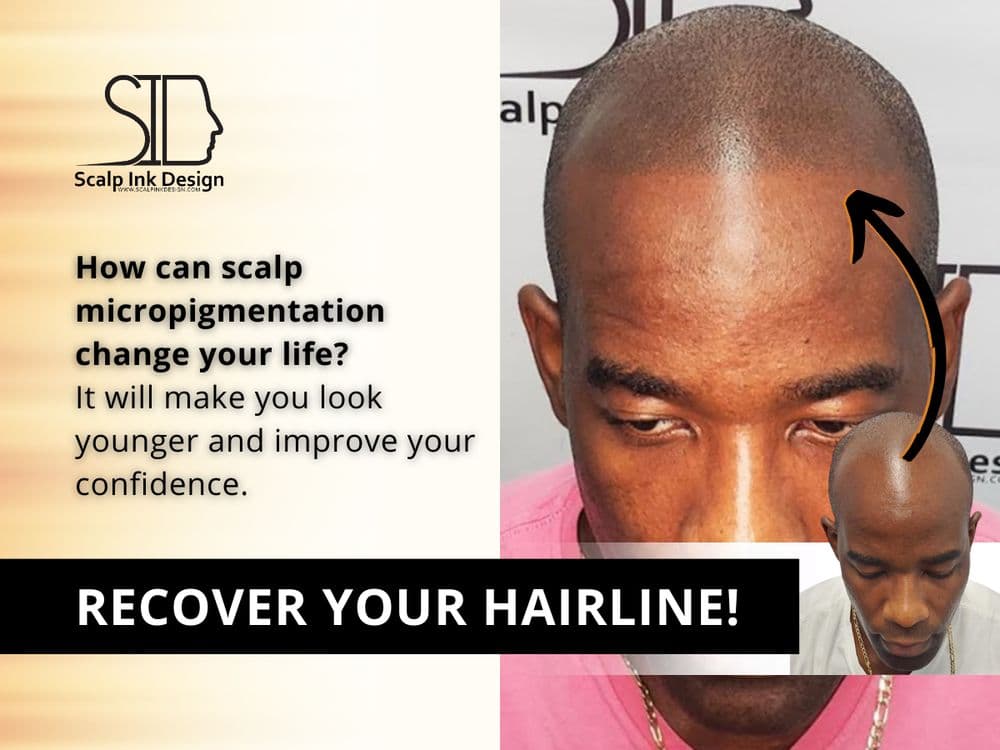 Scalp Ink Design - hair transplant in Miami, FL