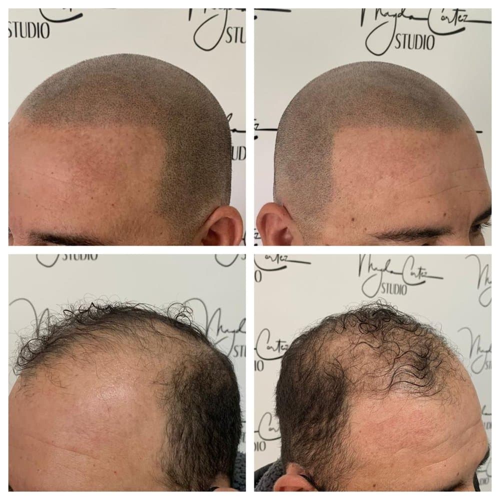 Magda Cortez Studio - hair transplant in San Diego, CA