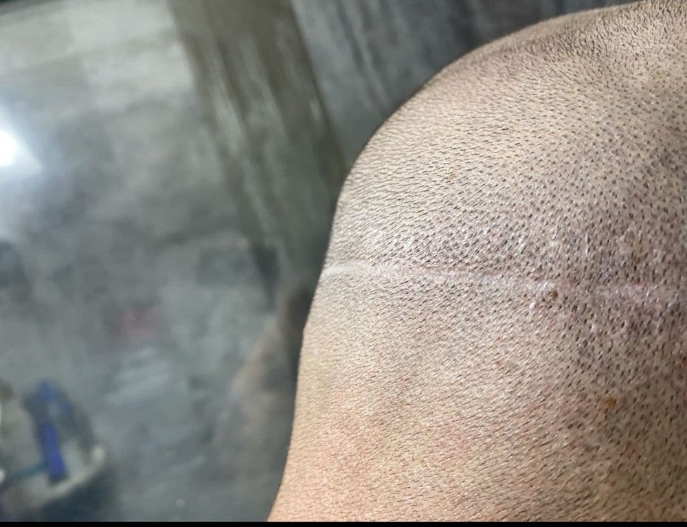 ForHair Hair Transplant Clinic - hair transplant in Alpharetta, GA
