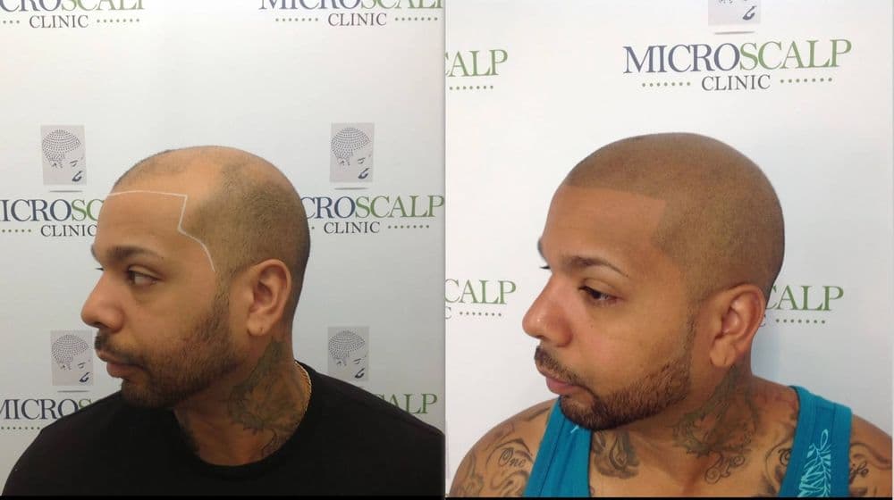 Microscalp Clinic - hair transplant in Fairhaven, MA