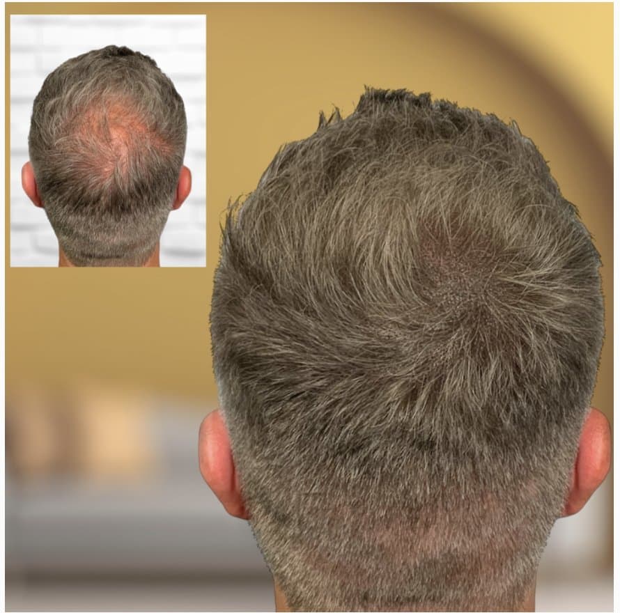 SMP Co by Jaden - hair transplant in San Jose, CA