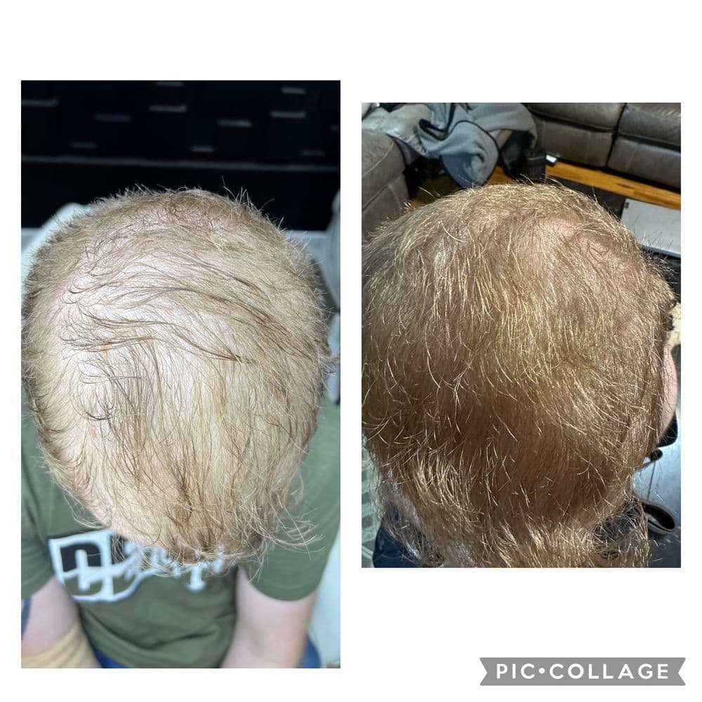 Hair Loss Solutions - hair transplant in Kirkwood, MO