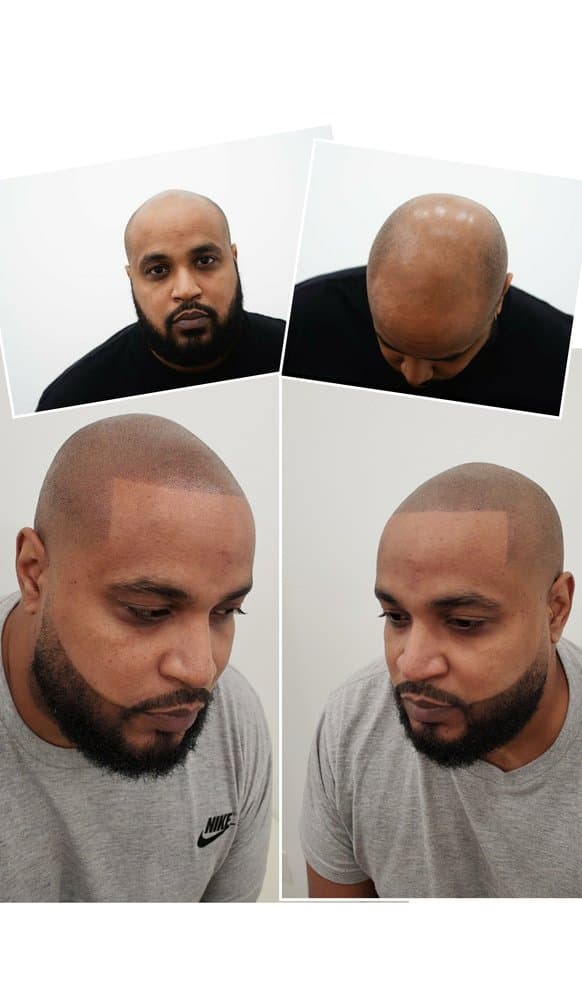 Artisan Scalp Micropigmentation - hair transplant in Elizabeth, NJ