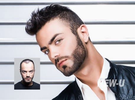 New-U - hair transplant in Rochester, NY