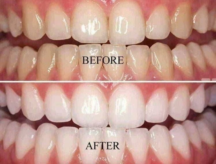 Exclusive Micro Scalp - hair transplant in West Warwick, RI