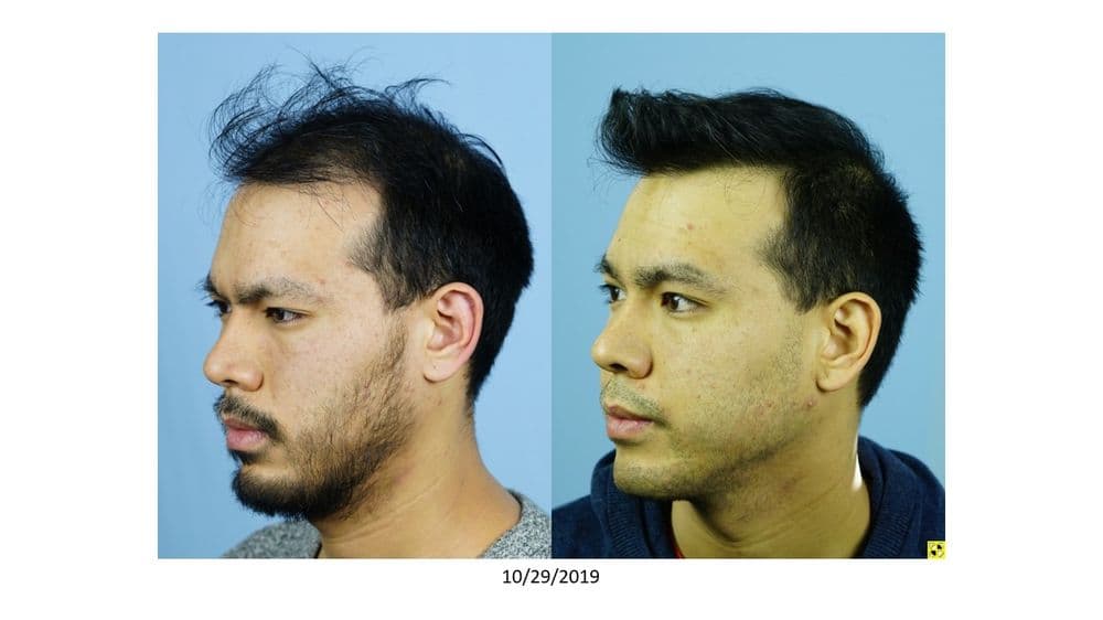 Shapiro Medical Group - hair transplant in Minneapolis, MN