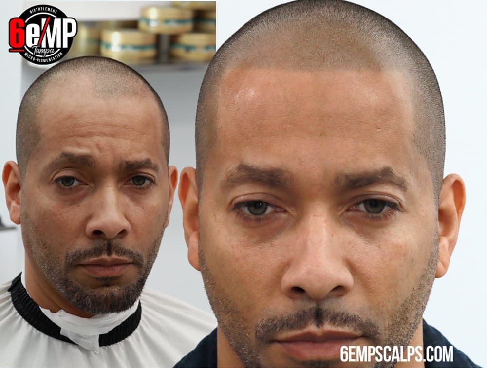 6e Micro - hair transplant in Brandon, FL