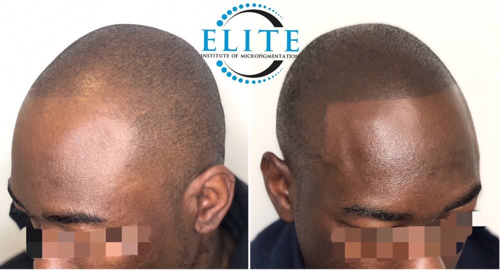 Scalp Masters Atlanta - hair transplant in Chamblee, GA