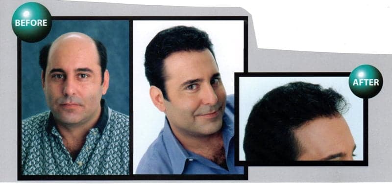 Advantage Hair C--b - hair transplant in Tampa, FL